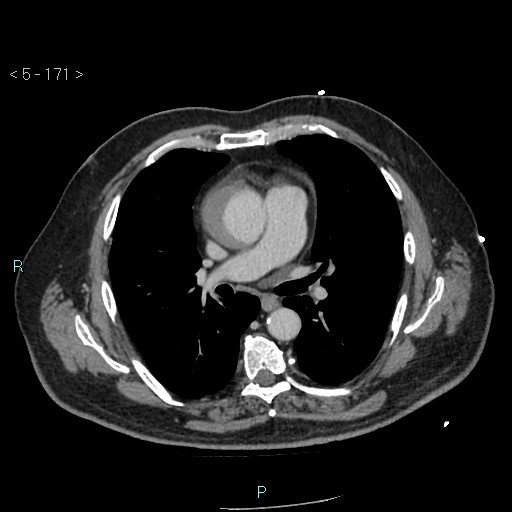 File:Aortic intramural hematoma (Radiopaedia 48463-53380 C 77).jpg