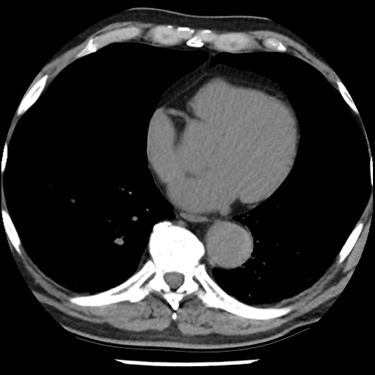 Aortic intramural hematoma (type B) (Radiopaedia 79323-92387 Axial non-contrast 35).jpg