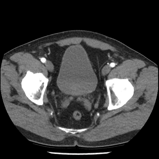 Aortic intramural hematoma (type B) (Radiopaedia 79323-92387 B 107).jpg