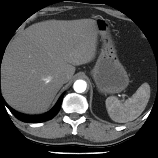 Aortic intramural hematoma (type B) (Radiopaedia 79323-92387 B 51).jpg