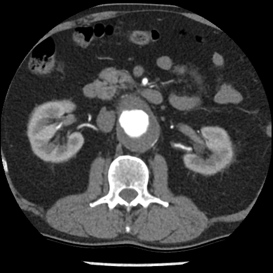 File:Aortic intramural hematoma (type B) (Radiopaedia 79323-92387 B 68).jpg