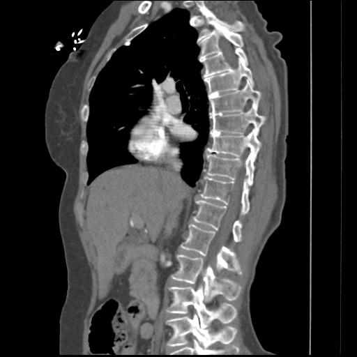 File:Aortic intramural hematoma from penetrating atherosclerotic ulcer (Radiopaedia 31137-31836 B 29).jpg