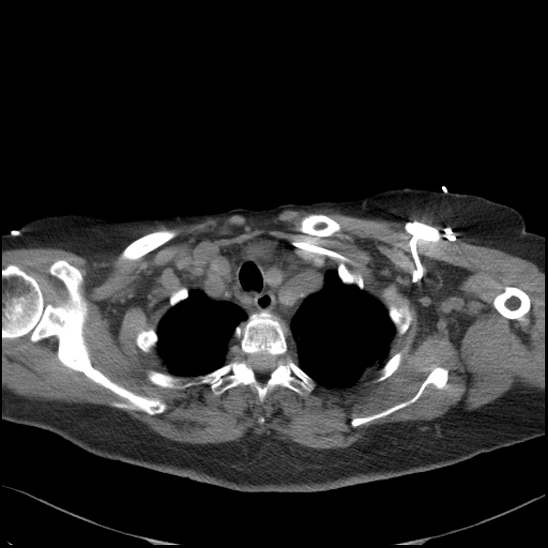 Aortic intramural hematoma with dissection and intramural blood pool (Radiopaedia 77373-89491 Axial non-contrast 18).jpg