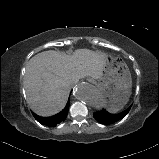 File:Aortic intramural hematoma with dissection and intramural blood pool (Radiopaedia 77373-89491 Axial non-contrast 84).jpg