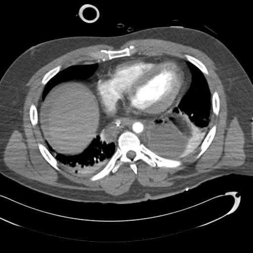 Aortic transection, diaphragmatic rupture and hemoperitoneum in a complex multitrauma patient (Radiopaedia 31701-32622 A 58).jpg