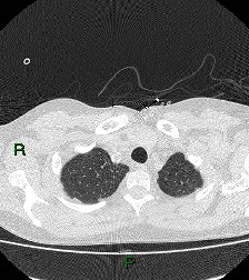 File:Aortic valve endocarditis (Radiopaedia 87209-103485 Axial lung window 18).jpg