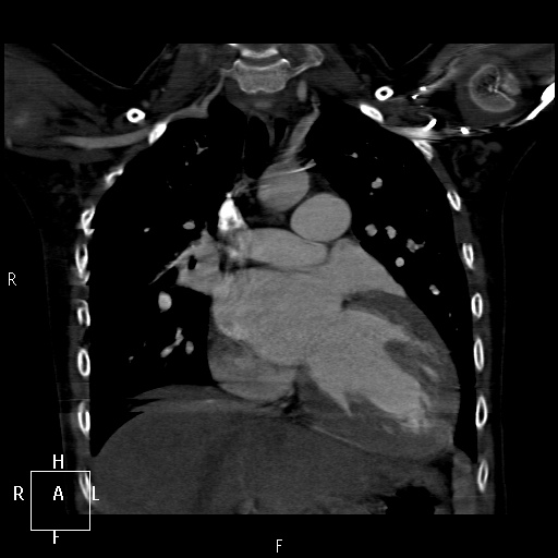 File:Aortopulmonary septal defect (Radiopaedia 41990-45013 Coronal C+ CTPA 26).jpg