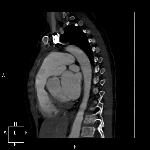 File:Aortopulmonary septal defect (Radiopaedia 41990-45013 Sagittal C+ CTPA 21).jpg