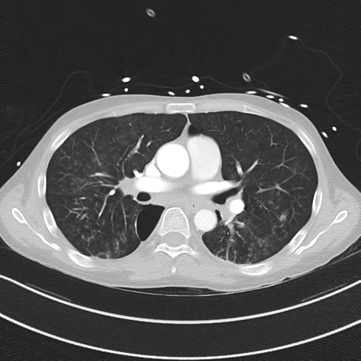 Apical bullous disease in a heavy smoker (Radiopaedia 33067-34092 Axial lung window 31).png