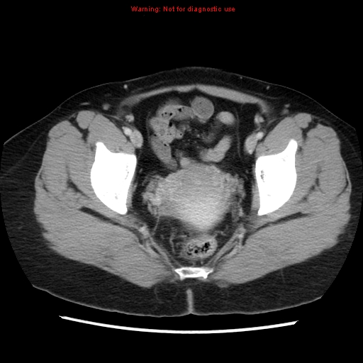 Appendiceal mucinous cystadenoma (Radiopaedia 8263-9111 Axial liver window 73).jpg
