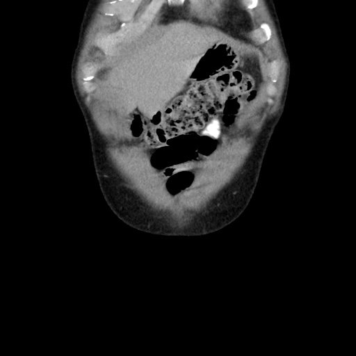 File:Appendicitis complicated by post-operative collection (Radiopaedia 35595-37113 B 10).jpg