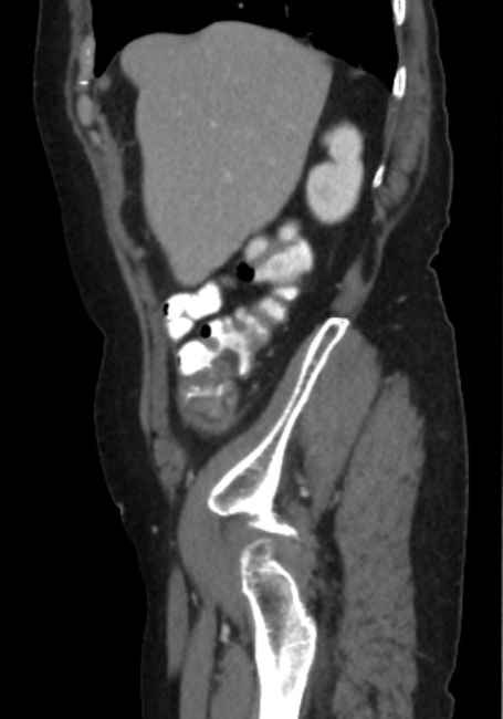 Appendicitis due to chicken fibula (Radiopaedia 74314-85198 C 18).jpg