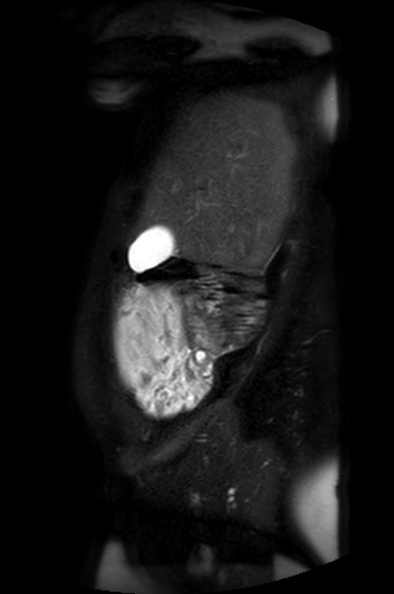 Appendicitis in gravida (MRI) (Radiopaedia 89433-106395 Sagittal T2 SPAIR 53).jpg