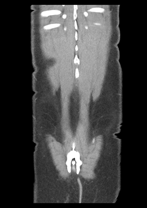 Appendicitis with thickening of the terminal ileum (Radiopaedia 42432-45550 B 54).png