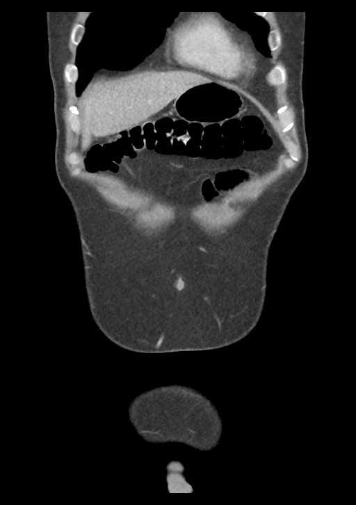 Appendicitis with thickening of the terminal ileum (Radiopaedia 42432-45550 B 8).png