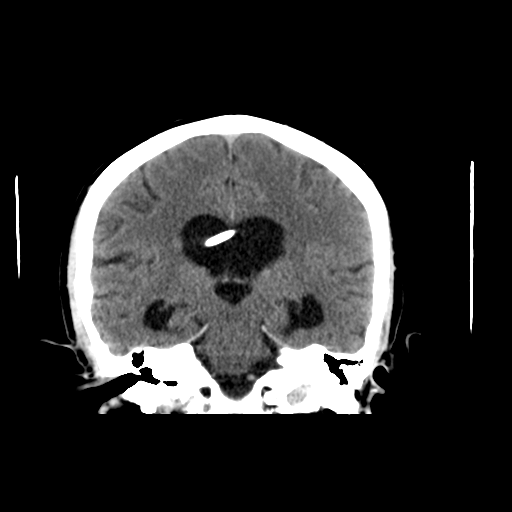 File:Aqueduct stenosis with corpus callosum hypoattenuation post shunting (Radiopaedia 37212-38973 Axial non-contrast 1).png