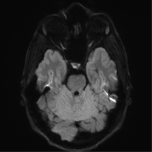 File:Arachnoid cyst - cerebellopontine angle (Radiopaedia 59689-67083 Axial DWI 48).png