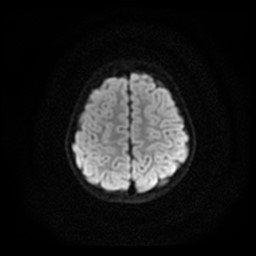 Arachnoid cyst - middle cranial fossa (Radiopaedia 86780-102938 Axial DWI 6).jpg