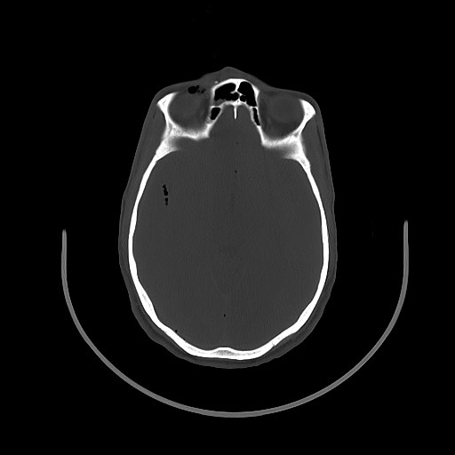 Arrow injury to the brain (Radiopaedia 72101-82607 Axial bone window 68).jpg