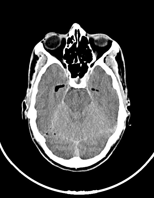 Arrow injury to the brain (Radiopaedia 72101-82607 Axial non-contrast 62).jpg