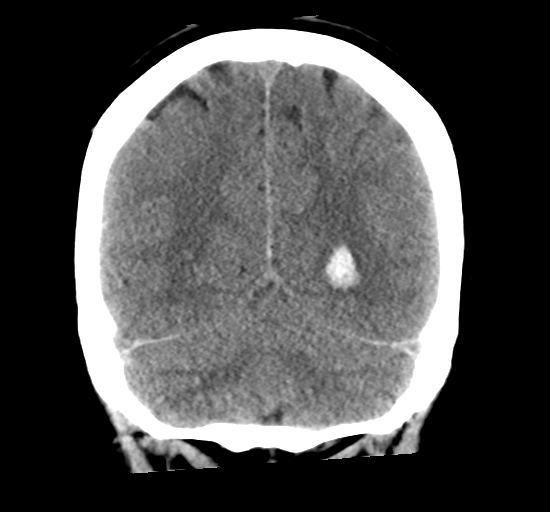 File:Arteriovenous malformation (cerebral) (Radiopaedia 40070-42579 Coronal non-contrast 29).png