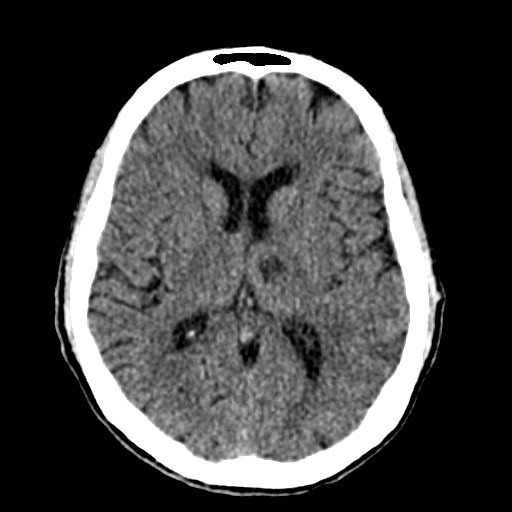 File:Artery of Percheron infarct (Radiopaedia 48088-52893 Axial non-contrast 23).jpg