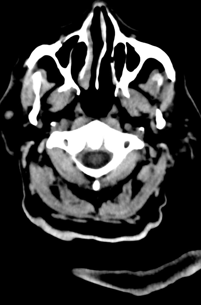Artery of Percheron infarction (Radiopaedia 80613-94202 Axial non-contrast 8).jpg