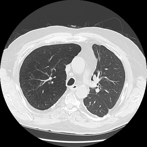 Asbestos-related pleural disease (Radiopaedia 74366-85250 Axial lung window 43).jpg