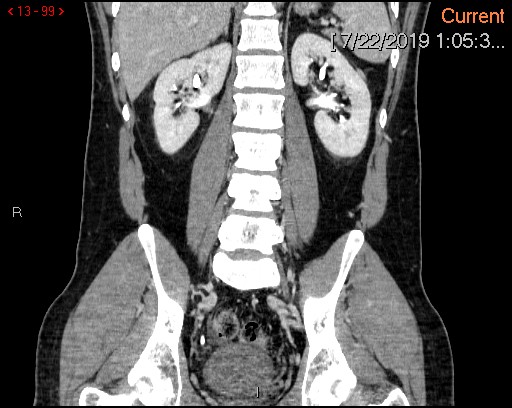 File:Ascending colonic diverticulum mimicking acute appendicitis (Radiopaedia 69943-80198 B 99).jpg