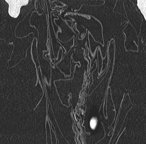Aspergilloma- with Monod sign (Radiopaedia 44737-48532 Coronal lung window 94).jpg