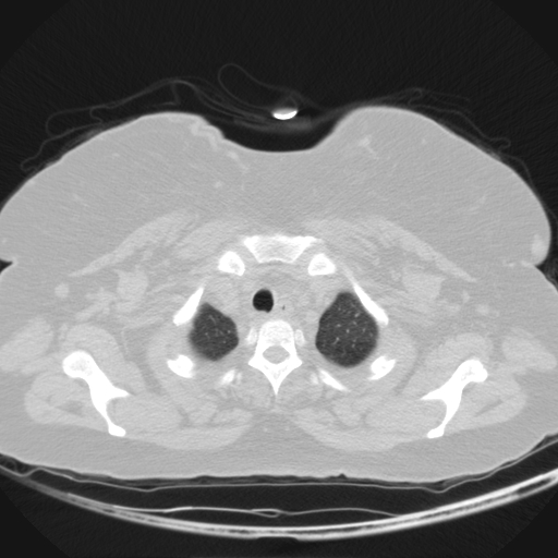 Aspergilloma (Radiopaedia 39611-41932 Axial lung window 6).jpg