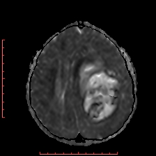 File:Astroblastoma (Radiopaedia 74287-85162 Axial ADC 42).jpg