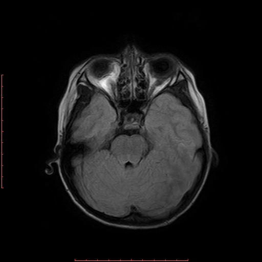 File:Astroblastoma (Radiopaedia 74287-85162 Axial FLAIR 6).jpg