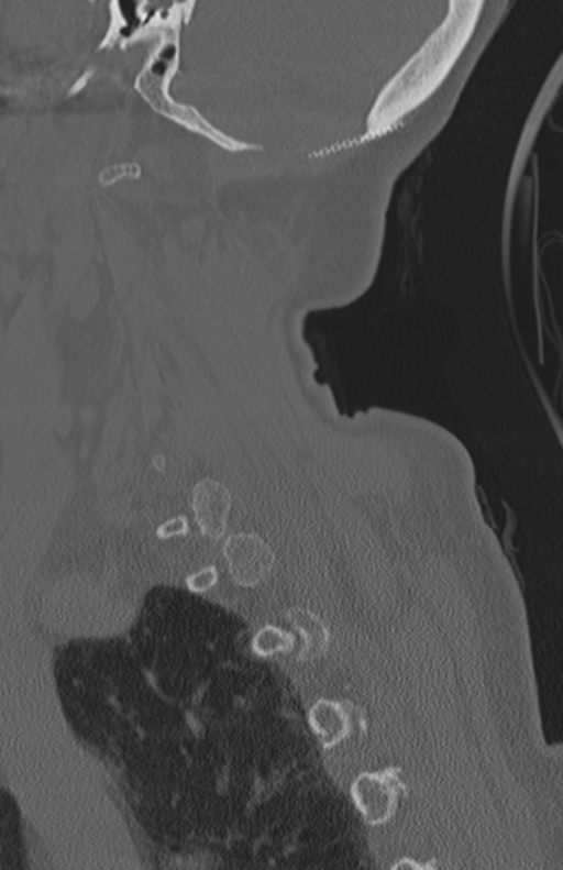 Atlanto-axial subluxation (Radiopaedia 36610-38176 Sagittal bone window 63).png