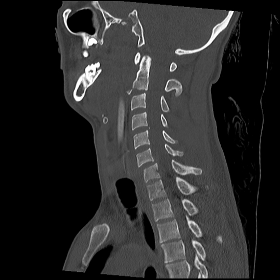 Atlanto-occipital dissociation (Traynelis type 1), C2 teardrop fracture, C6-7 facet joint dislocation (Radiopaedia 87655-104061 Sagittal bone window 38).jpg