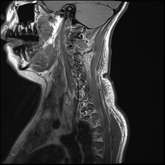 File:Atlanto-occipital dissociation - Traynelis type 1 (Radiopaedia 87570-103950 Sagittal T1 14).jpg
