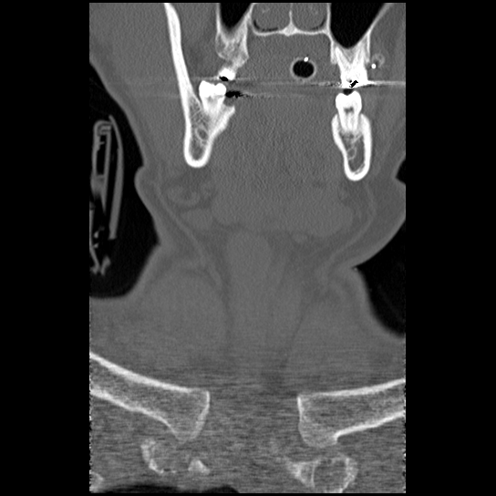 Atlanto-occipital dissociation injury (Radiopaedia 29274-29698 Coronal bone window 56).png