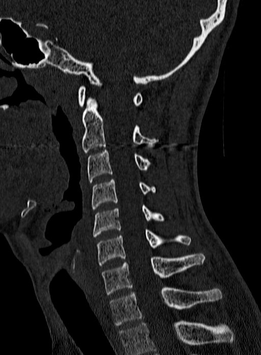 Atlantoaxial subluxation (Radiopaedia 44681-48450 Sagittal bone window 86).jpg