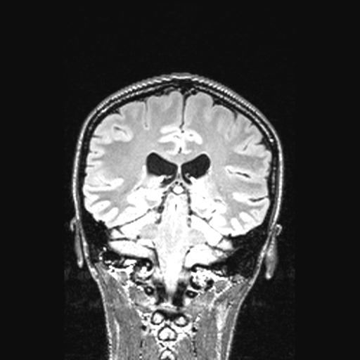 Atretic encephalocoele with inferior vermis hypoplasia (Radiopaedia 30443-31108 Coronal FLAIR 75).jpg