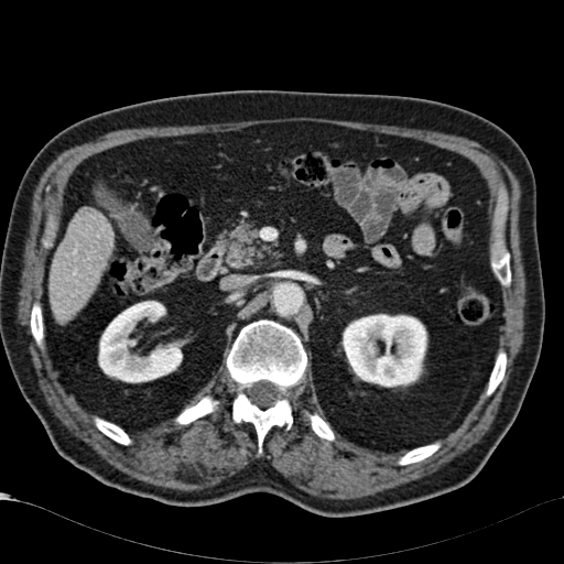 Atypical hepatocellular carcinoma (Radiopaedia 41744-44698 B 37).jpg