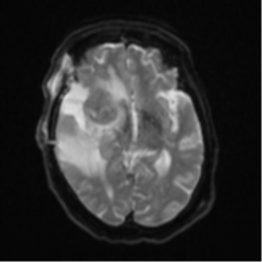 File:Atypical meningioma (WHO Grade II) (Radiopaedia 54742-60981 Axial DWI 13).png