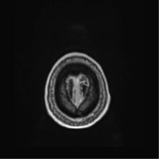 File:Atypical meningioma (WHO grade II) with brain invasion (Radiopaedia 57767-64729 Axial T1 C+ 49).png