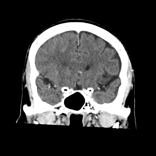Atypical meningioma (WHO grade II) with osseous invasion (Radiopaedia 53654-59715 Coronal C+ delayed 23).png