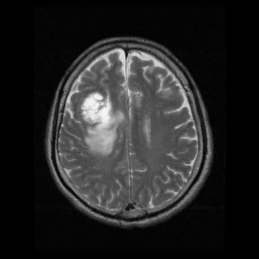 File:Atypical meningioma (WHO grade II) with osseous invasion (Radiopaedia 53654-59716 Axial T2 15).png