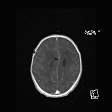 File:Atypical teratoid rhabdoid tumor (prenatal US and neonatal MRI) (Radiopaedia 59091-66388 Axial T1 C+ 46).jpg