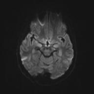 Autoimmune limbic encephalitis (Radiopaedia 30363-31005 Axial B0 and DWI 45).jpg