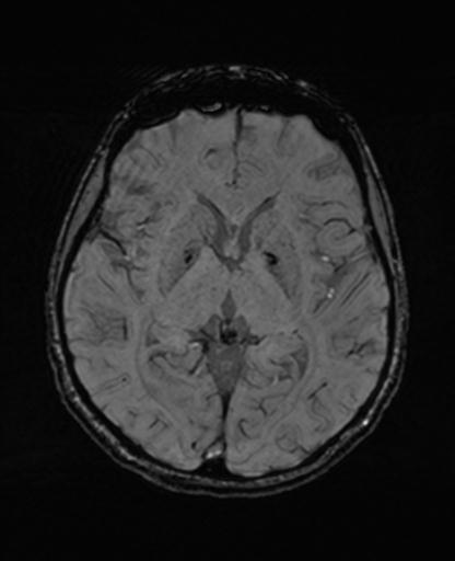 Autoimmune limbic encephalitis (Radiopaedia 30363-31005 SWI 39).jpg