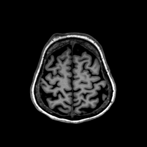 Autoimmune limbic encephalitis (Radiopaedia 30363-31005 T1 Axial 1mm 125).jpg