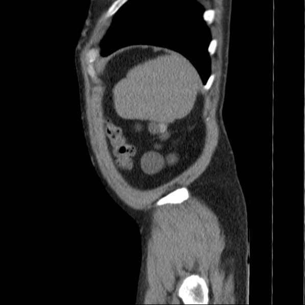 File:Autosomal dominant polycystic kidney disease (Radiopaedia 36539-38101 D 75).jpg