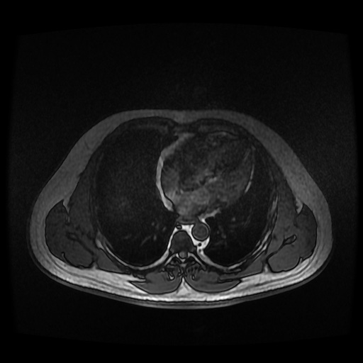 Autosomal dominant polycystic kidney disease (Radiopaedia 50259-55611 Axial 2D Dual Echo 3).jpg